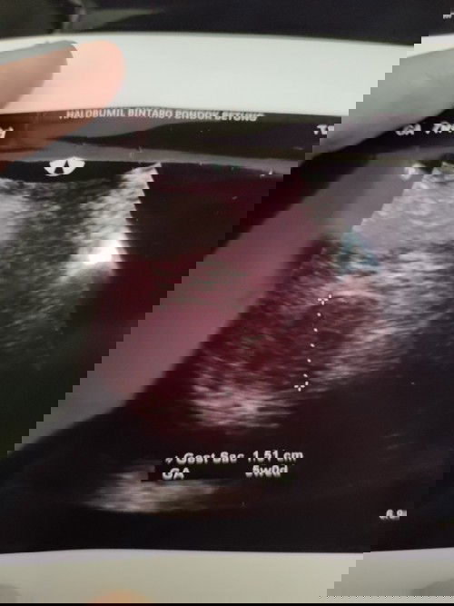 USG terakhir ada kantung janin usia 5 Minggu, di usg lagi 3 Minggu kemudian kantungnya tidk terlihat