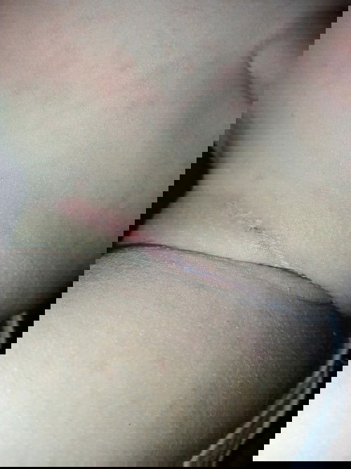 Bungang araw po ba ito?