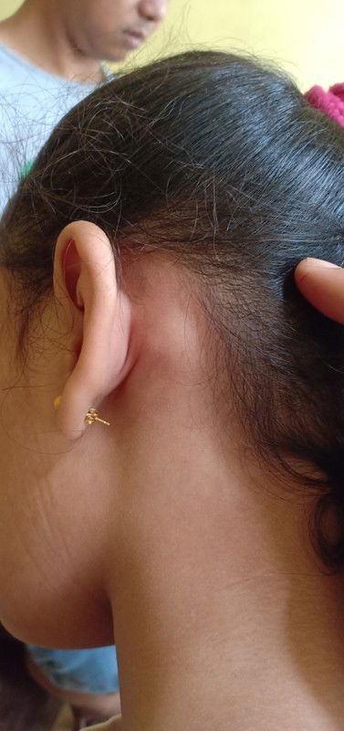 Benjolan di belakang telinga