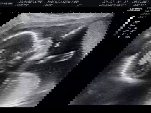 แชร์ประสบการณ์การเจาะน้ำคร่ำครั้งแรกและเป็นลูกคนแรกคะ