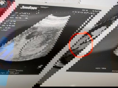 Fibroid semasa mengandung?