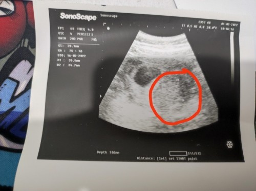Fibroid semasa mengandung?
