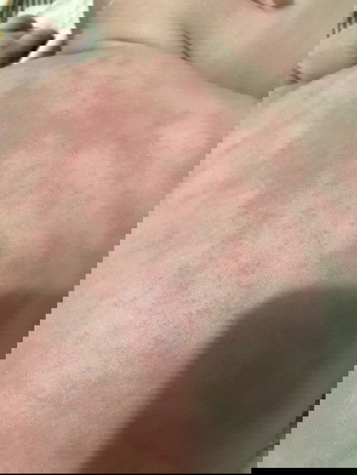 Kemerahan pd bayi 4bln