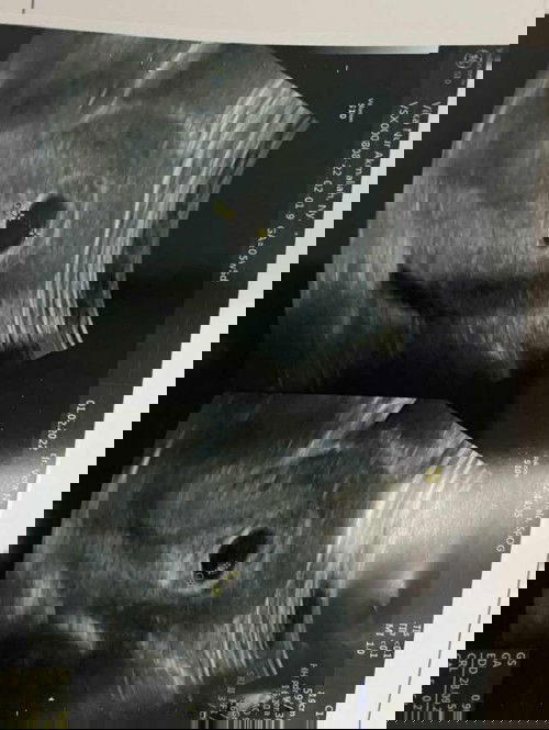 Hasil USG ada yg serupa kah bun?