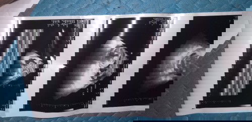 My Baby is No heartbeat in my womb.