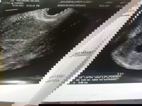 Baru kantong janin 5 minggu?? wajar gak bun?