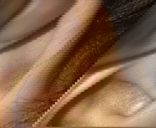 ตุ่มที่หูน้อง7เดือน