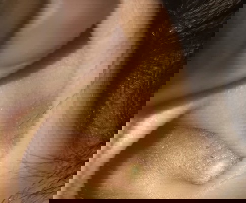 ตุ่มที่หูน้อง7เดือน