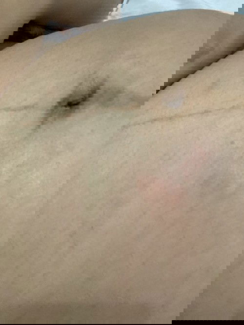 Usia 7 bulan perut gatal dan ada bercak merah seperti d gigit serangga