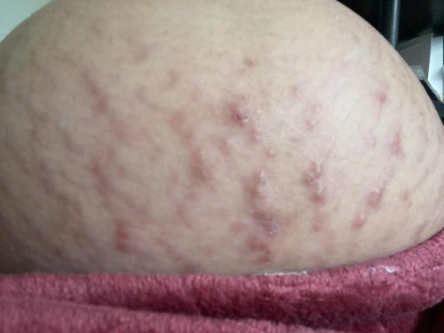 Itchy stretchmarks