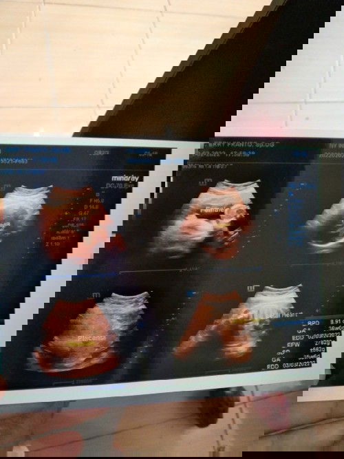 Kemungkinan SC krna Ambeien , masih kecil tpi udah kilat kata dokter nya .