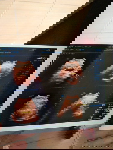 Kemungkinan SC krna Ambeien , masih kecil tpi udah kilat kata dokter nya .