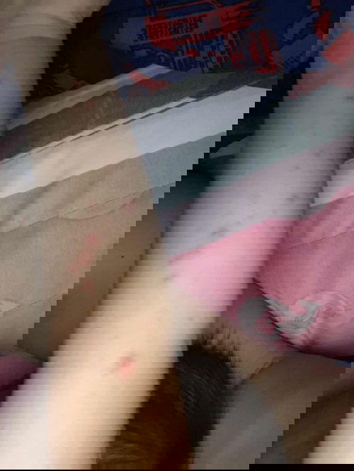 Bintik merah setelah demam