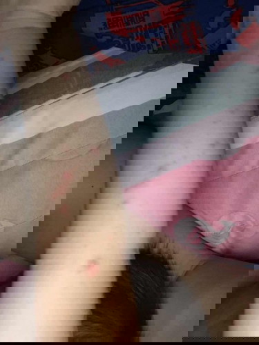 Bintik merah setelah demam