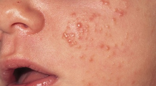 Chàm ở trẻ sơ sinh có tự khỏi dc k?