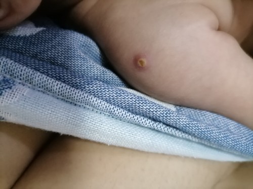 แผลปลูกฝีมีหนอง