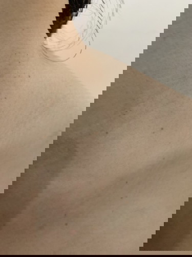 Spurts of brown spots on neck