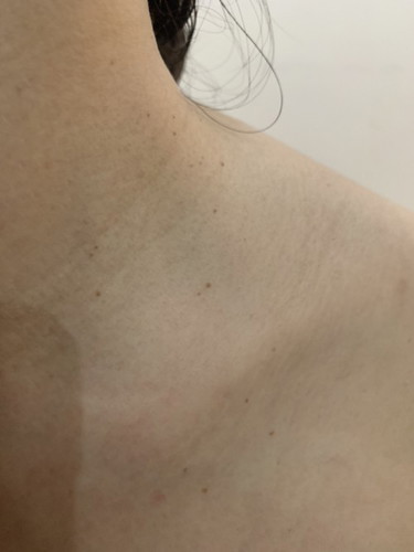 Spurts of brown spots on neck