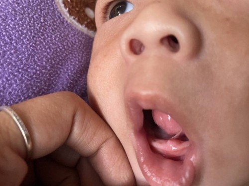 ใช่ฟันจะขึ้นไหมคะ