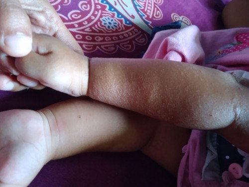 Bintik2 pada kulit bayi