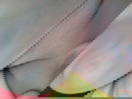 Kulit kering bersisik