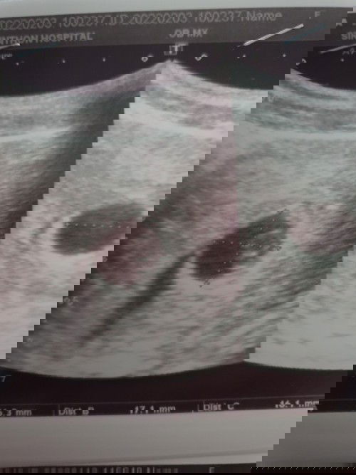 มีใครเคยท้องลมมั๊ยค่ะ มาแชร์ข้อมูลให้เตรียมพร้อมหน่อยค่ะ