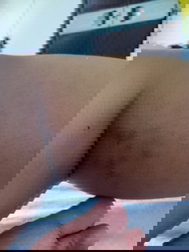 Stretchmark