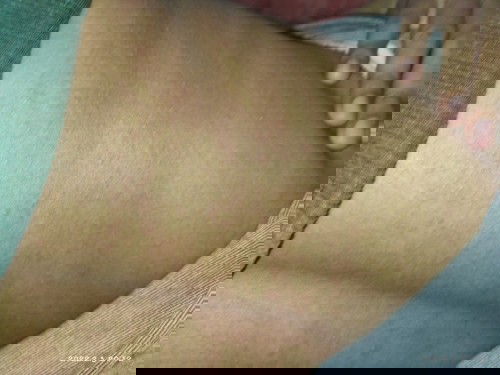 Bintik-bintik merah pasca melahirkan normal