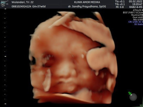 Cara cepat naikin BB janin gimana ya Bun? Yang sudah berpengalaman boleh banget bantu sharingnya