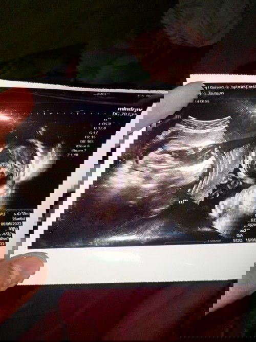 USG 2d pada kehamilan 6bulan