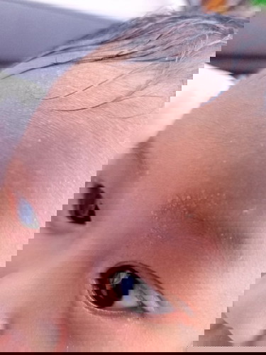 Rashes sa kilay