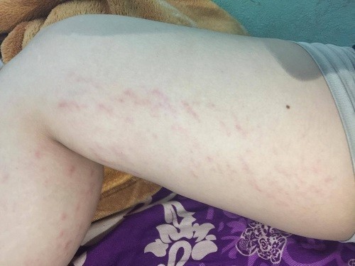 Rạn da bà bầu có hết dc k?