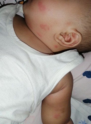 4 months, rashes after shots