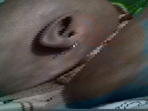 Bercak putih pada bayi