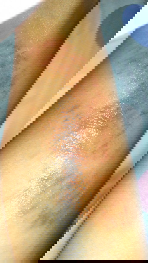 Eksim (dermatitis atopic)