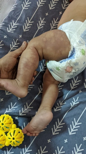 Marks on Baby legs