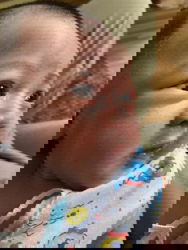 ลูก 18 วันขึ้นเม็ดเเบบนี้ปกติไม ?