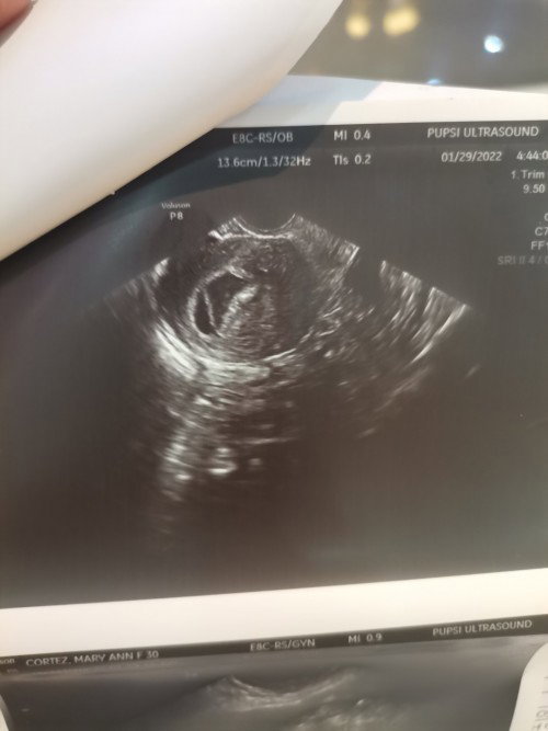 Hi Momshies, I'm expecting for twins. Kaso may bleeding😞? Nati-take ako Duphaston as per my OB.....