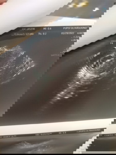 Hi Momshies, I'm expecting for twins. Kaso may bleeding😞? Nati-take ako Duphaston as per my OB.....