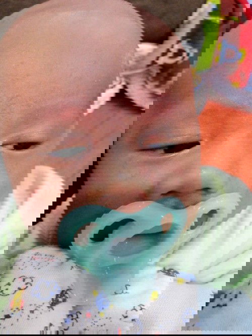 Ruam muka.. Sesiapa yg tahu bgaimana nk ilangkn ruam ni dr muka ank sye..