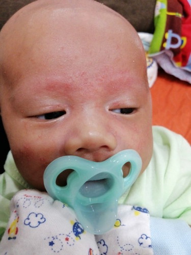 Ruam muka.. Sesiapa yg tahu bgaimana nk ilangkn ruam ni dr muka ank sye..