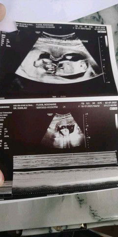 anterior myometrial wall contraction Normal Po Ba? Sana po may makasagot po agad