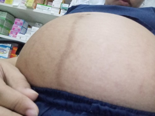 Stretch Marks