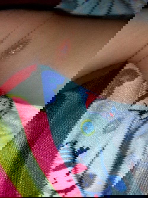 Kaki nya seperti di gigit serangga