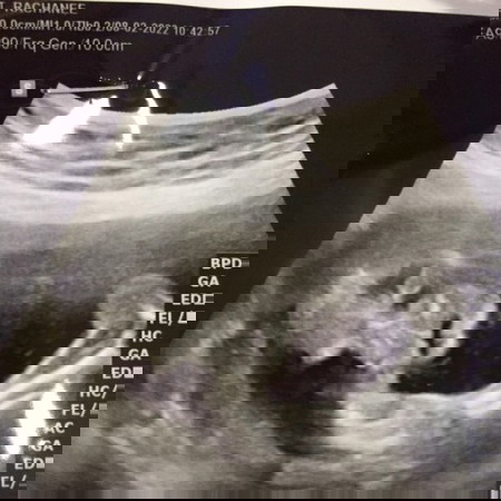 อัลตราซาวด์วันนี้ค่ะ คุณแม่ๆรู้ไหมคะว่าน้องอยู่ตรงไหน แม่มองไม่ออกเลยค่ะ