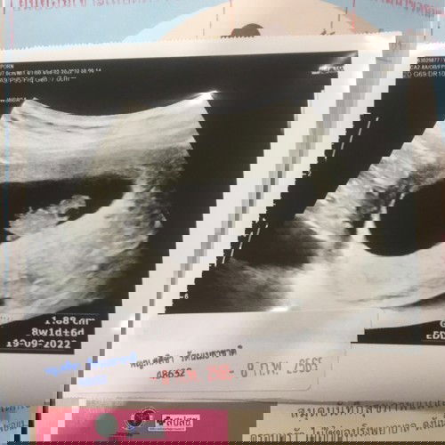 ซาวด์เจอถุงน้ำที่หัวเด็ก