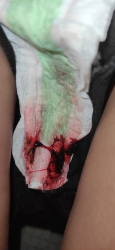 Blood clot 10 weeks pregnant