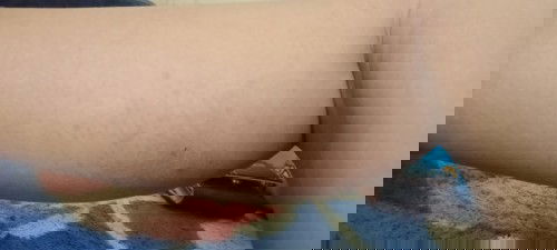 Kulit muncul warna hitam