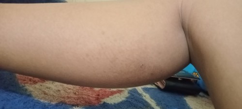 Kulit muncul warna hitam