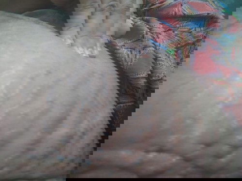 Stretchmark bergelembung dan sakit pasca melahirkan